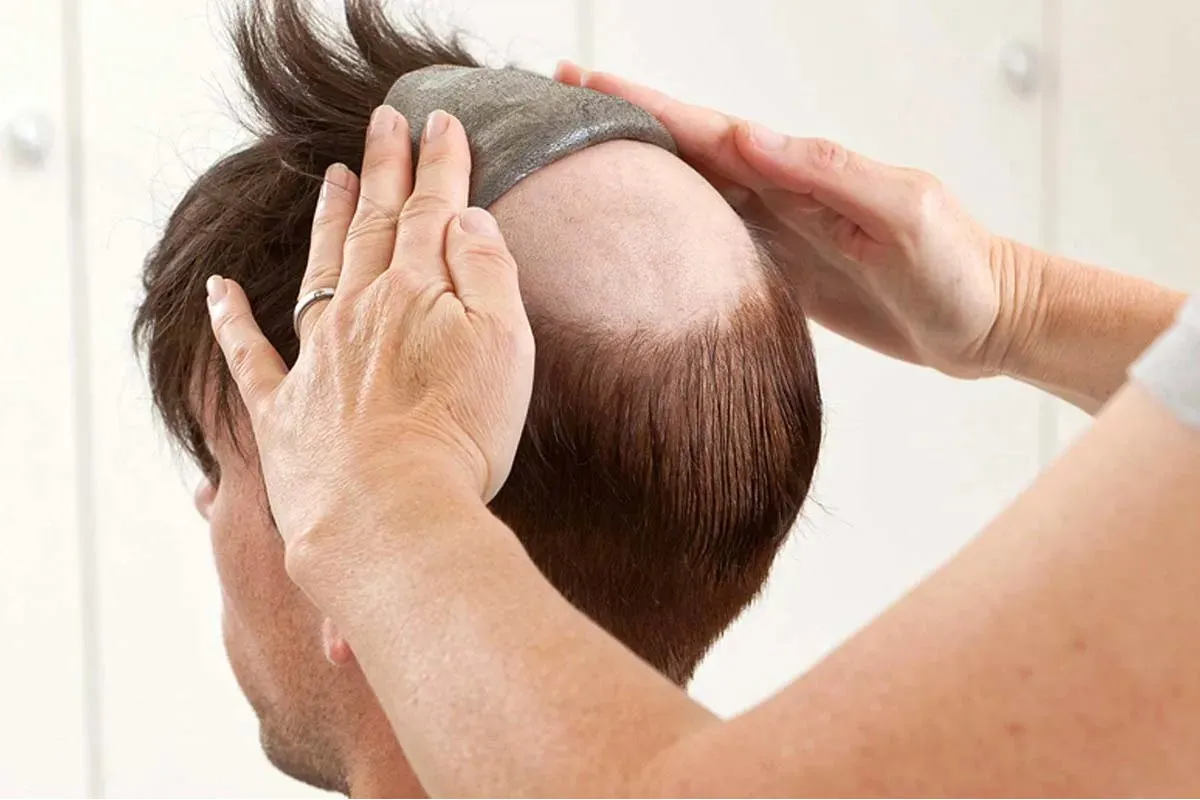 تفاوت پروتز دائمی و موقت مو